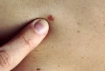 Как проявляется рак кожи