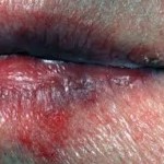 Признаки рака губы 