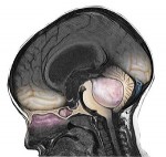 Медуллобластома головного мозга
