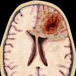 Глиобластома головного мозга