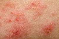 Атопичный дерматит может обладать превентивными антираковыми свойствами